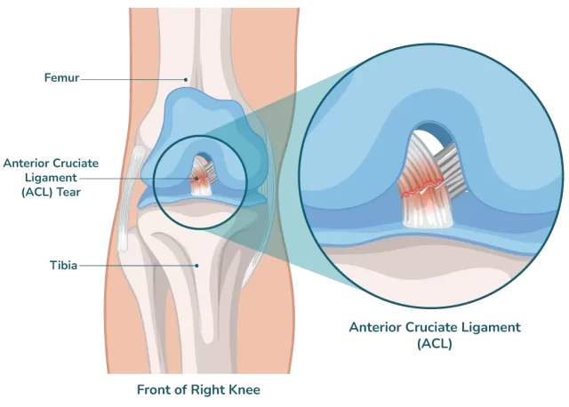 ACL Diagram ACL Diagram