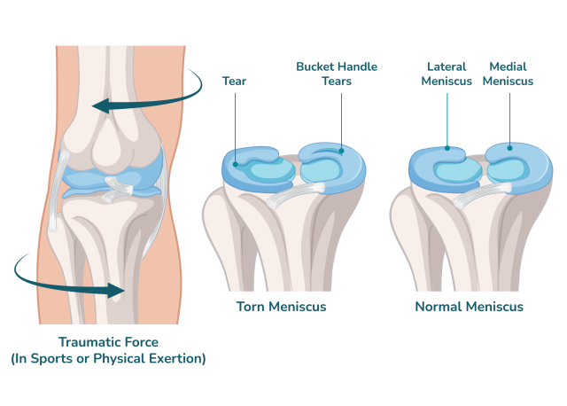 image_OrthoKinetics_Meniscus-min-640x458-1 https://passionindesign.com/files/image_OrthoKinetics_Meniscus-min-640x458-1.png